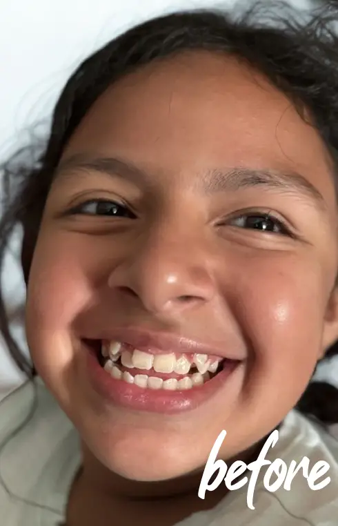 before-janariah-braces-armani