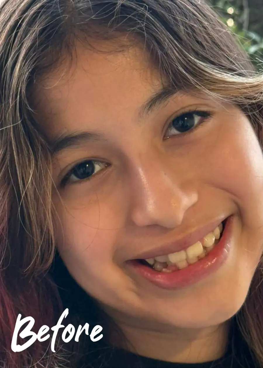 Vanessa Before Treatment